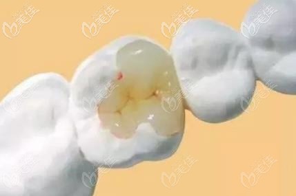 在北京用玻璃材質(zhì)補(bǔ)牙示意圖