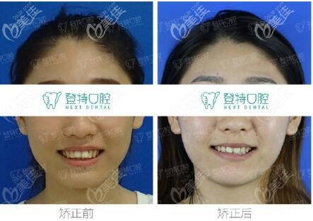 深圳登特口腔齙牙矯正<span style= 深圳登特口腔齙牙矯正<span style=