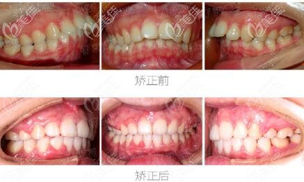 深圳登特口腔牙齒矯正怎么樣?太棒了,我門牙前凸戴的金屬自鎖牙套竟然矯正過(guò)來(lái)了
