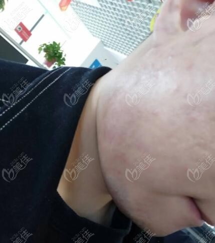 我在福州瑪恩醫(yī)院做了srt100淺層x射線治療疤痕疙瘩,6個月后沒有復發(fā)很靠譜