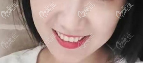 正畸后的我自信了 正畸后的我自信了