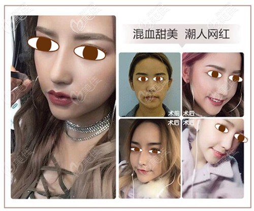 鼻小柱、鼻翼寬大修復(fù)案例