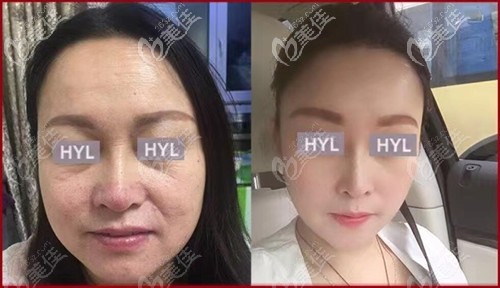 韓藝來整形拉皮案例