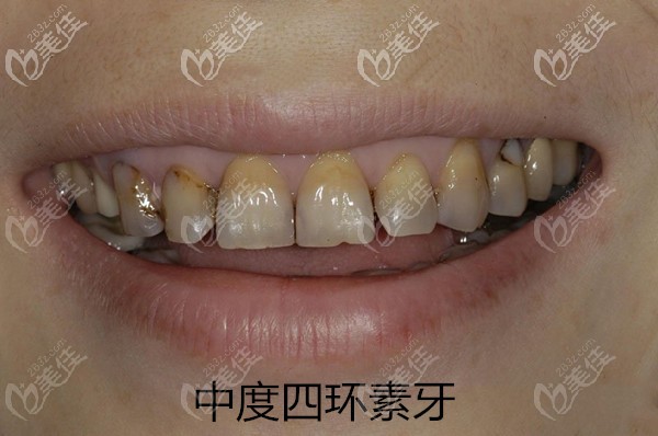 中度四環(huán)素牙