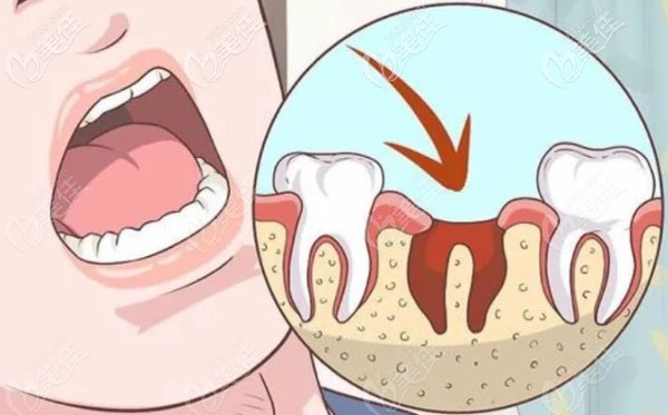 寧波的拔牙收費價格