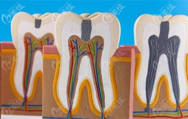 牙冠的收費標準