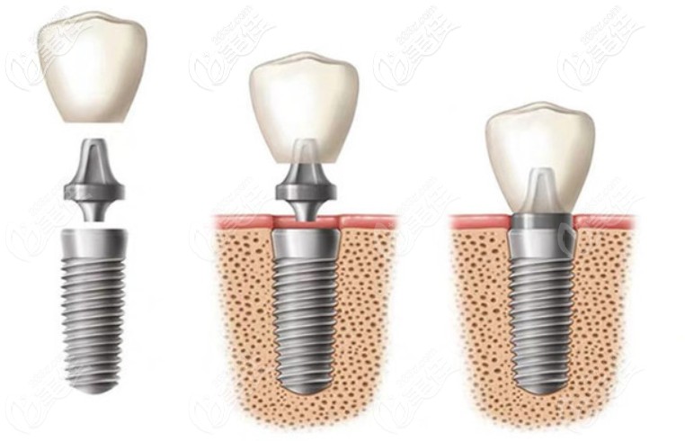 德國(guó)CAMLOG種植牙系統(tǒng)的構(gòu)成