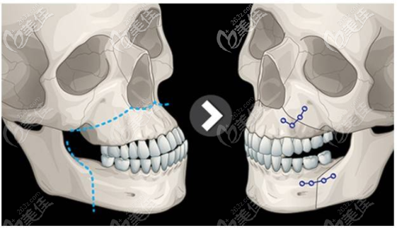 廣東美恩王友元醫(yī)生做正頜手術(shù)怎么樣 廣東美恩王友元醫(yī)生做正頜手術(shù)怎么樣