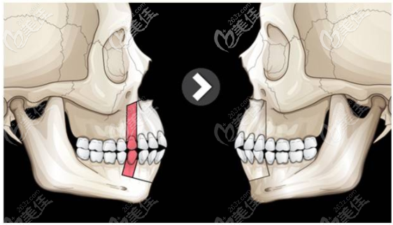 王友元正頜技術(shù)優(yōu)勢及方法 王友元正頜技術(shù)優(yōu)勢及方法