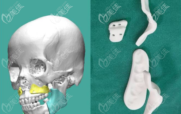 廣州美恩王友元3D正頜導(dǎo)板 廣州美恩王友元3D正頜導(dǎo)板