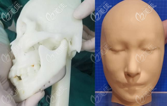 廣州美恩王友元3d定制技術(shù)修復(fù)骨缺損 廣州美恩王友元3d定制技術(shù)修復(fù)骨缺損