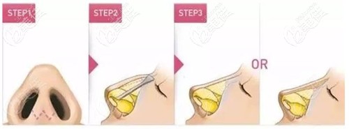 駝峰鼻手術(shù)過程