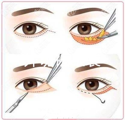 眼周提升手術(shù)切口 眼周提升手術(shù)切口