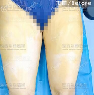 5G維密脂雕吸脂瘦大腿術(shù)前照 5G維密脂雕吸脂瘦大腿術(shù)前照
