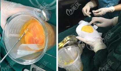 5G維密脂雕吸出的脂肪 5G維密脂雕吸出的脂肪