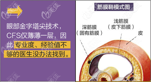 CFS聯(lián)合筋膜鞘眼修復(fù)技術(shù)