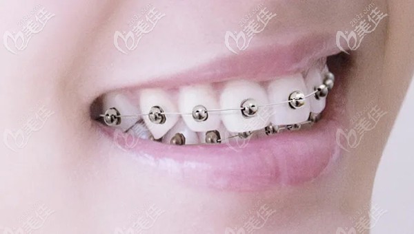 obrace球面自鎖托槽矯正好不好