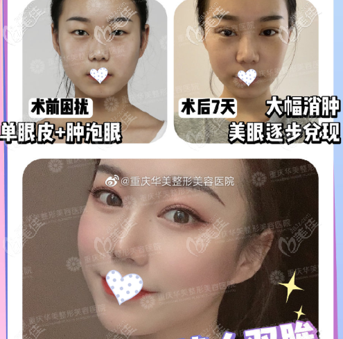 李富強院長開扇雙眼皮案例