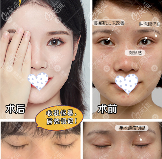 李富強雙眼皮修復(fù)案例