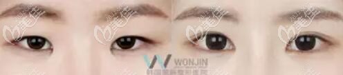 開內(nèi)眼角前后對比照 開內(nèi)眼角前后對比照