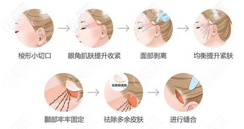 筋膜折疊手術過程