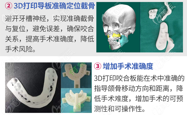 深圳何錦泉博士研發(fā)出的3D導板正頜技術很靠譜