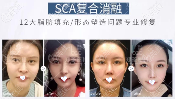 sca復合消融的瘦臉效果圖 sca復合消融的瘦臉效果圖