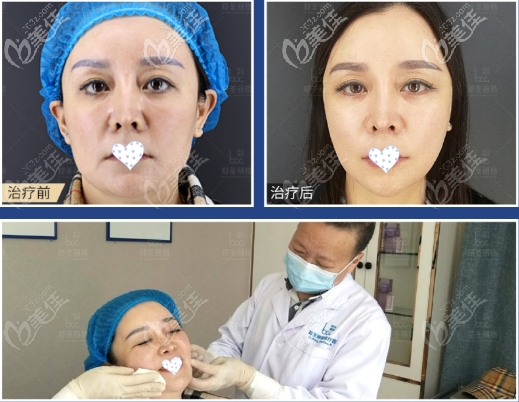 瘦臉效果很明顯 瘦臉效果很明顯