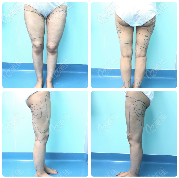 深圳曹孟君土麥森吸脂真實案例 深圳曹孟君土麥森吸脂真實案例