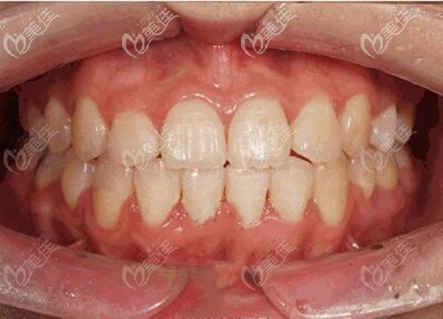 牙齒中度擁擠做矯正時并非都要拔牙,他戴陶瓷半隱形牙套不到兩年就ok