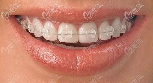 陶瓷半隱性矯正 陶瓷半隱性矯正