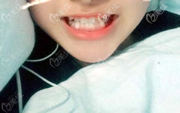 假性地包天 假性地包天