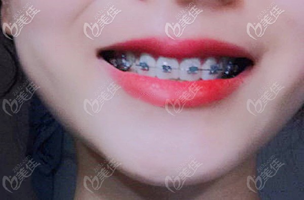 自鎖托槽矯正地包天 自鎖托槽矯正地包天