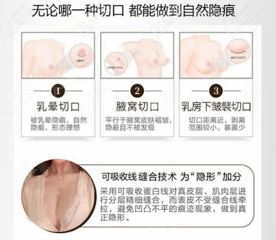 不知蕪湖隆胸哪家醫(yī)院好，看下蕪湖名姝朱唯力院長隆胸優(yōu)勢