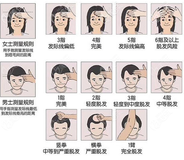 發(fā)際線高低自測表 發(fā)際線高低自測表