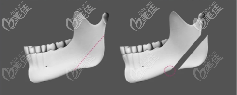 一代1.0版?zhèn)鹘y(tǒng)磨骨技術(shù)