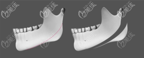 長(zhǎng)曲線磨骨技術(shù)