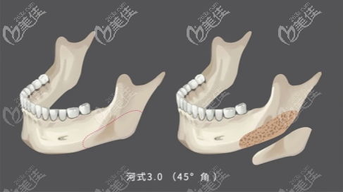 河式3.0版微創(chuàng)磨骨技術(shù)