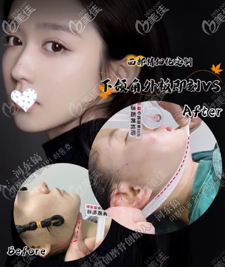 河?xùn)|鎬下頜角磨骨劈外板90°效果圖