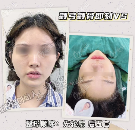 顴骨內(nèi)推5mm術(shù)后即刻效果圖