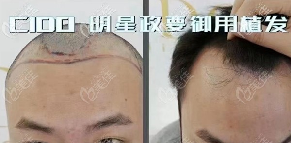 男士額角植發(fā)術(shù)前圖 男士額角植發(fā)術(shù)前圖