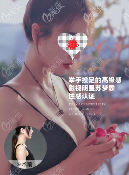 趙廣生假體隆胸對(duì)比案例