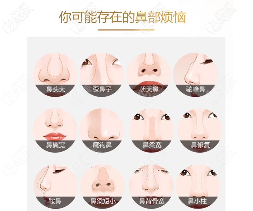 鼻頭大、朝天鼻、歪鼻都可以做隆鼻手術改善