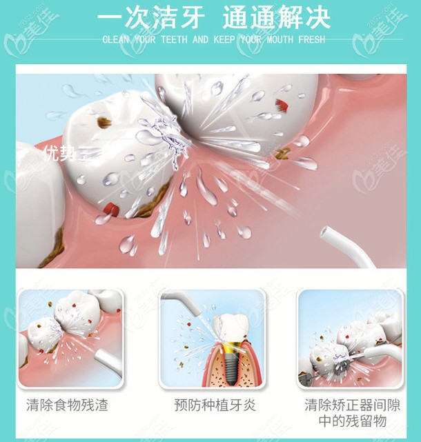 超聲波潔牙可預(yù)防種植牙炎