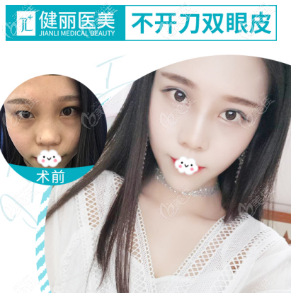 廣州健麗鐳射定位雙眼皮是怎么做的 廣州健麗鐳射定位雙眼皮是怎么做的