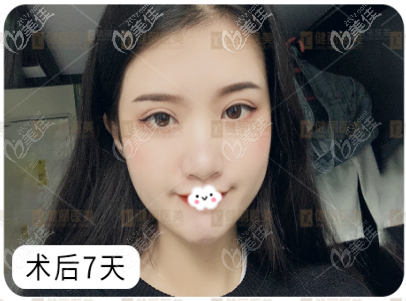 廣州健麗醫(yī)美鐳射定位不開刀雙眼皮恢復(fù)過程圖片 廣州健麗醫(yī)美鐳射定位不開刀雙眼皮恢復(fù)過程圖片