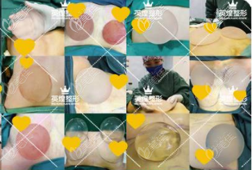 趙丹楊取出的假體情況