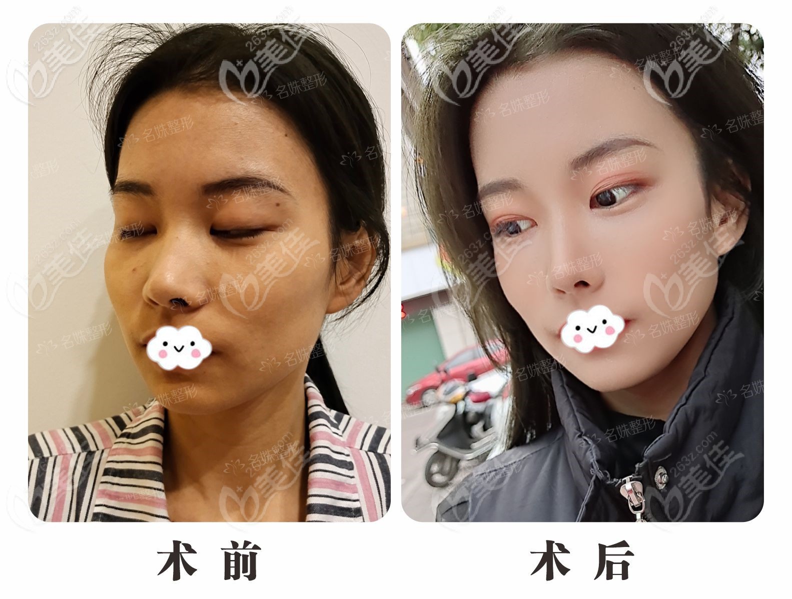 匯集蕪湖名姝美容醫(yī)院隆鼻案例圖：擔(dān)心鼻綜合手術(shù)失敗的小姐姐快來參考下