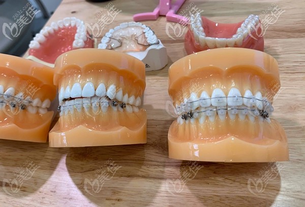 博德口腔牙齒矯正價(jià)格