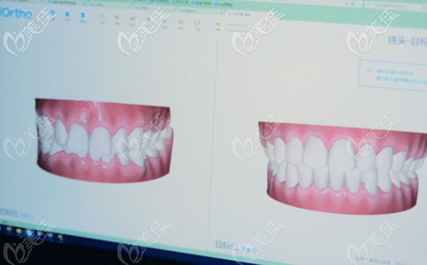 貝殼口腔引進(jìn)有口腔掃描儀 貝殼口腔引進(jìn)有口腔掃描儀